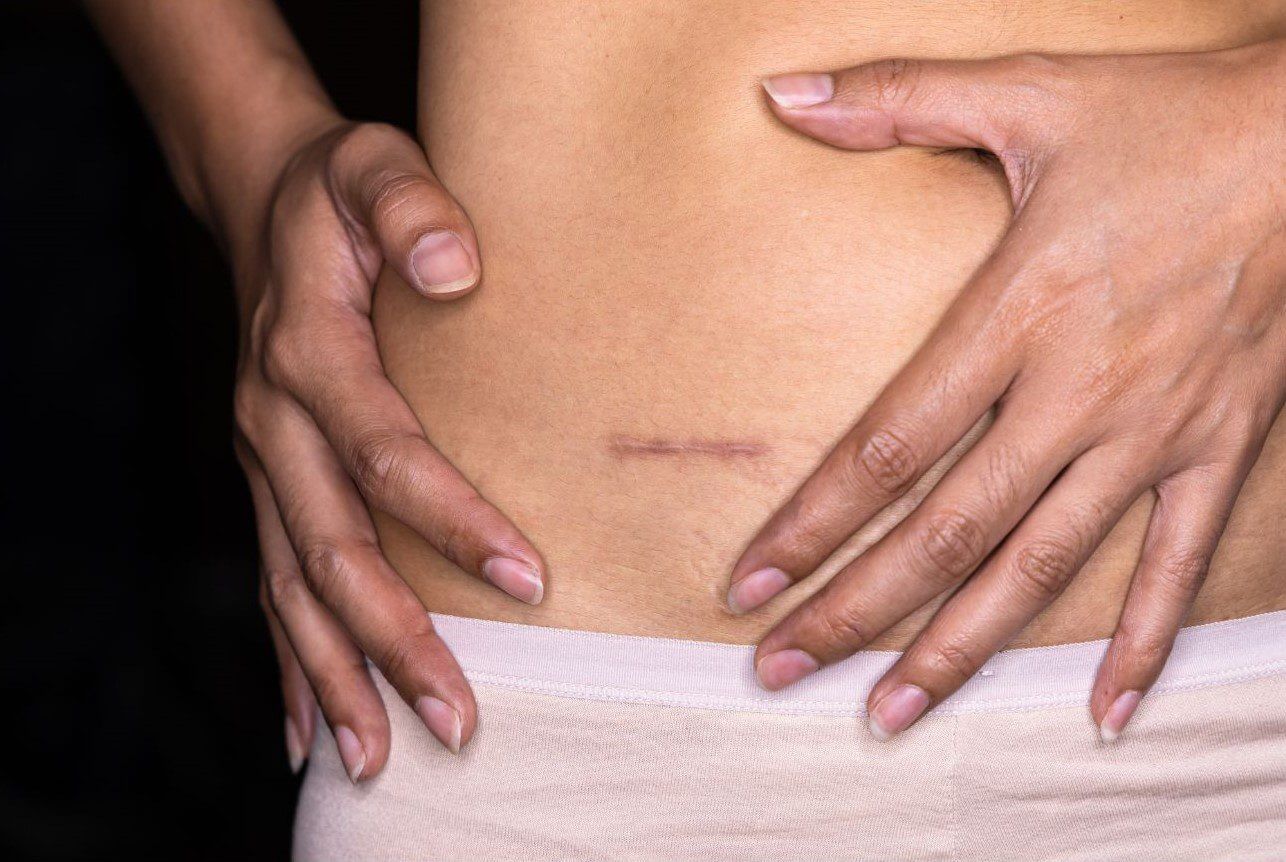 A woman with a visible small scar on her stomach, indicating a past injury.