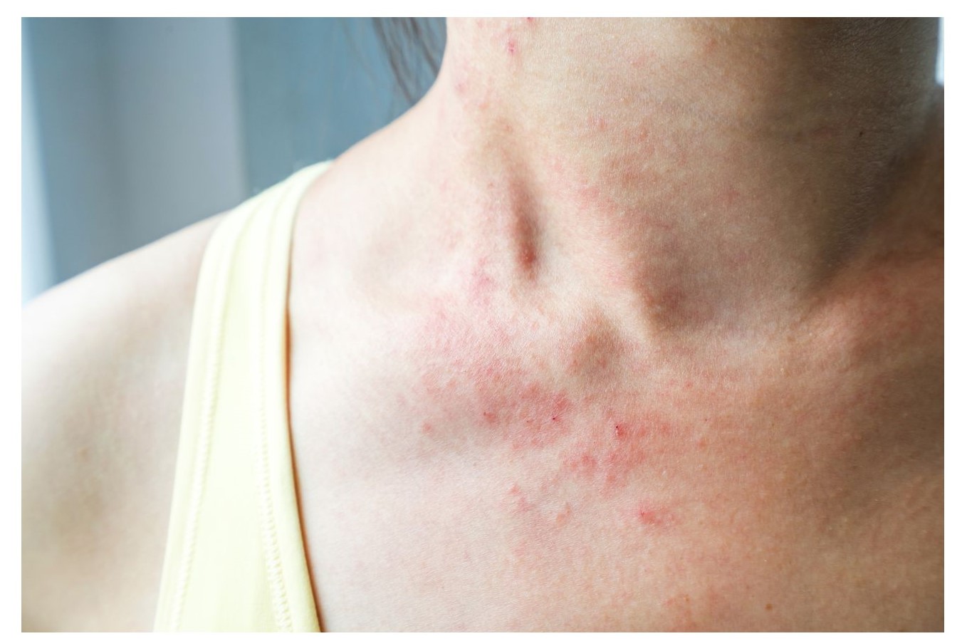 A person is showing their neck and upper chest, which has visible redness and skin blemishes.