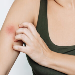 Allergies: Seasonal & Food