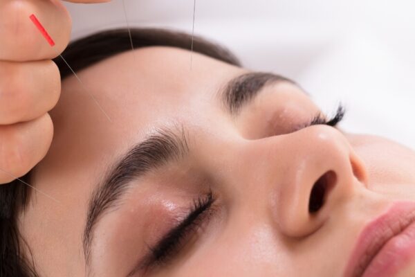 A practitioner performs acupuncture on a patient’s head to alleviate headache symptoms.