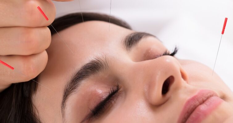 A practitioner performs acupuncture on a patient’s head to alleviate headache symptoms.