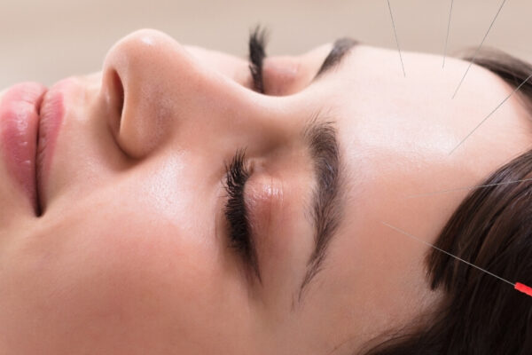 A practitioner performs acupuncture on a patient’s head to alleviate headache symptoms.