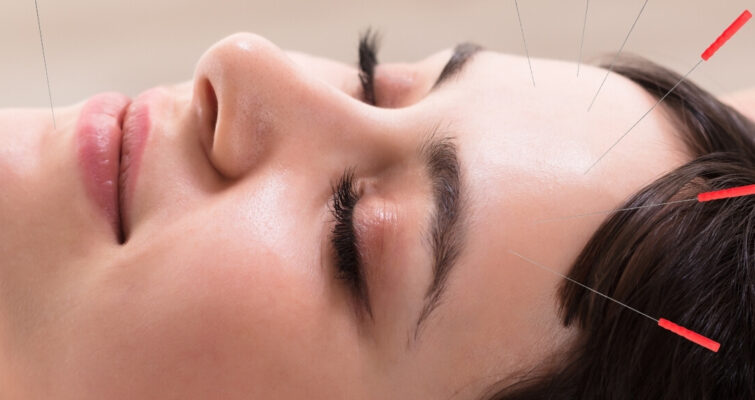 A practitioner performs acupuncture on a patient’s head to alleviate headache symptoms.