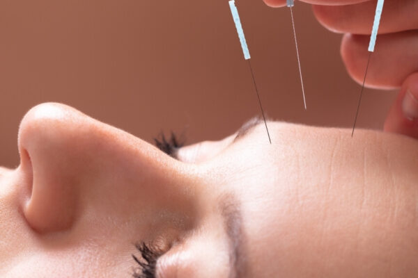 Acupuncture session focused on migraine relief, highlighting its rising popularity in Buckhead for facial treatments.