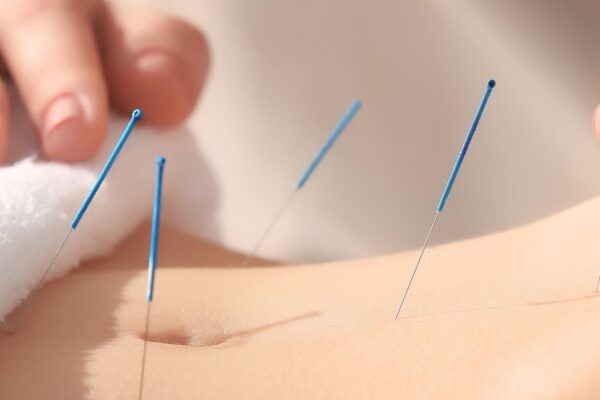 A practitioner performs acupuncture on a patient's back to alleviate pain, with needles inserted at specific points.