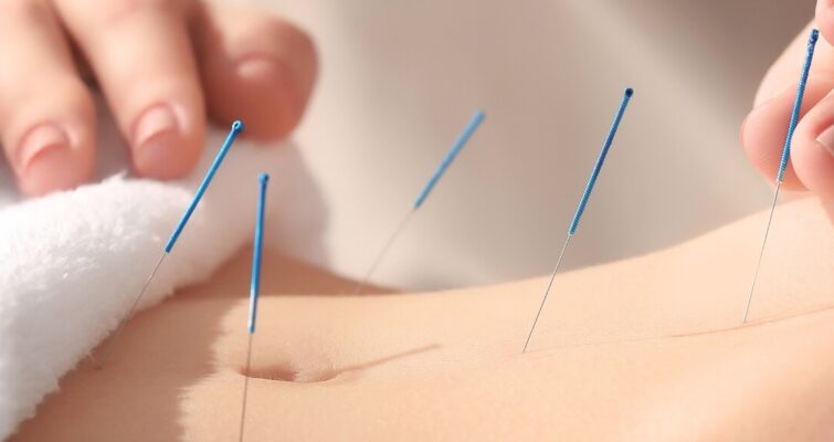 A practitioner performs acupuncture on a patient's back to alleviate pain, with needles inserted at specific points.
