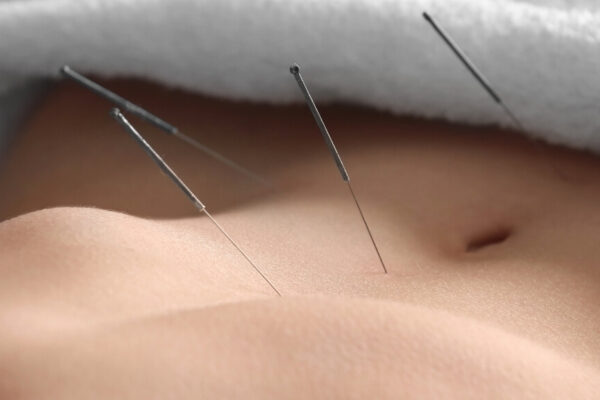 A woman receiving acupuncture treatment on her stomach, with needles gently placed on her abdomen.