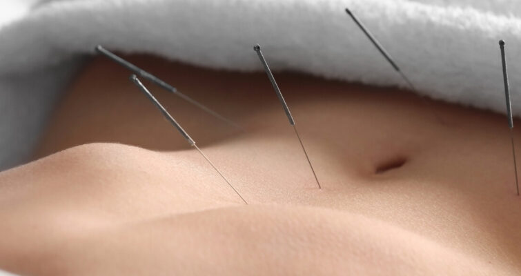 A woman receiving acupuncture treatment on her stomach, with needles gently placed on her abdomen.