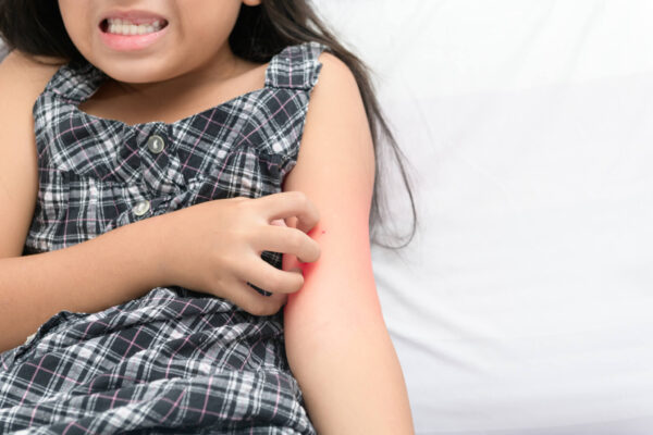 A young girl showing a red rash on her arm, illustrating eczema treatment in children.