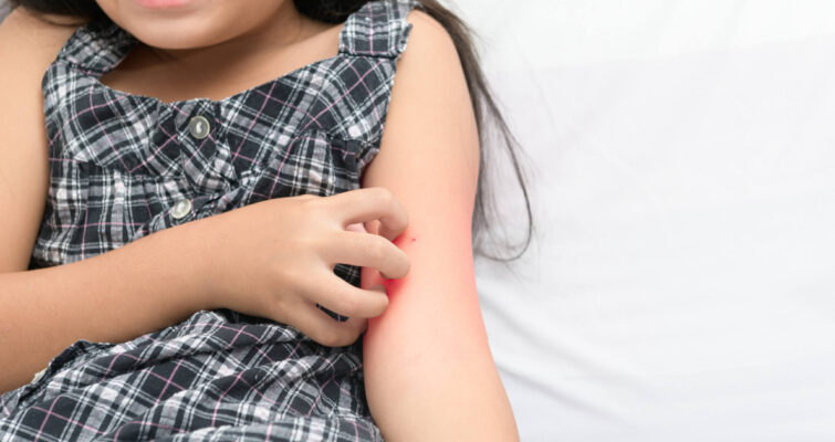 A young girl showing a red rash on her arm, illustrating eczema treatment in children.