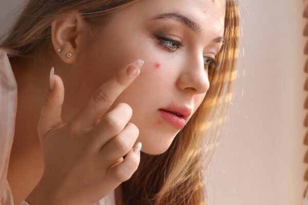 A woman examines her face in front of a window, reflecting on the effects of Chinese medicine for acne.
