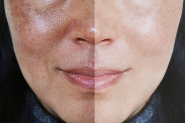A woman with a white face and black skin shows results before and after using a HydraFacial skin care product.