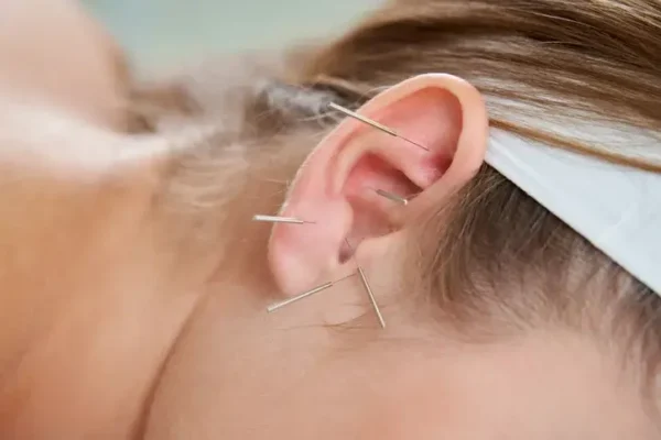 acupuncture