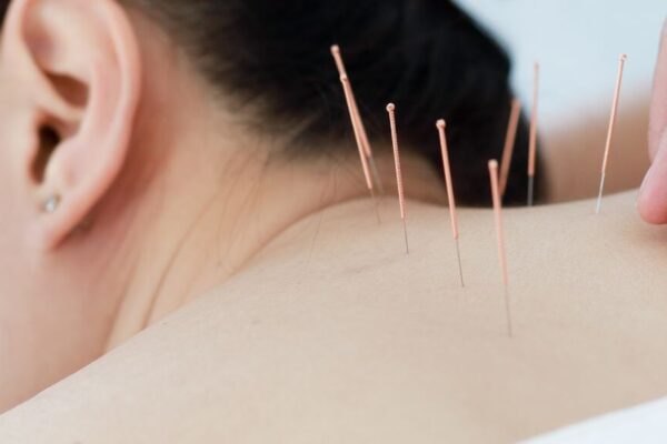 Acupuncture session focused on alleviating back pain, highlighting its benefits for healthier living.