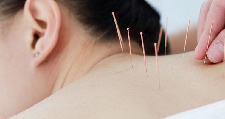 Acupuncture session focused on alleviating back pain, highlighting its benefits for healthier living.